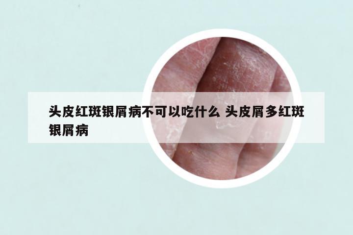头皮红斑银屑病不可以吃什么 头皮屑多红斑银屑病