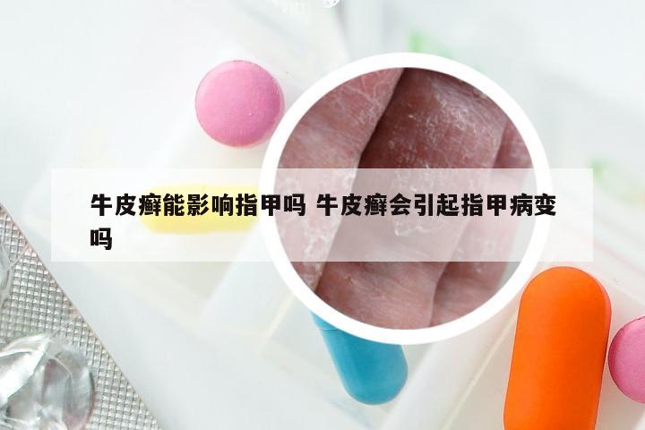 牛皮癣能影响指甲吗 牛皮癣会引起指甲病变吗