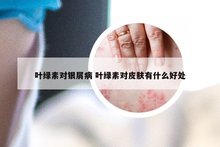 叶绿素对银屑病 叶绿素对皮肤有什么好处