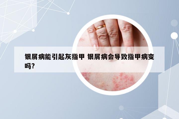银屑病能引起灰指甲 银屑病会导致指甲病变吗?