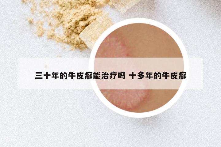 三十年的牛皮癣能治疗吗 十多年的牛皮癣