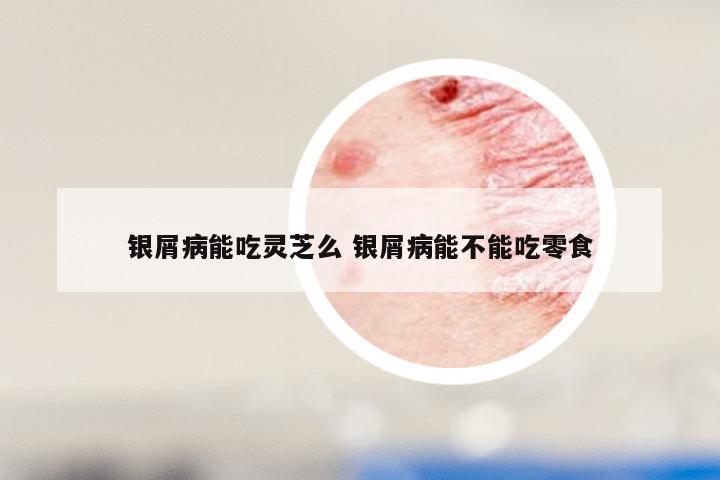 银屑病能吃灵芝么 银屑病能不能吃零食