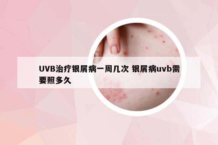 UVB治疗银屑病一周几次 银屑病uvb需要照多久
