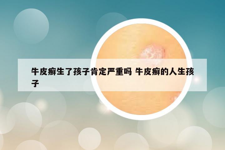 牛皮癣生了孩子肯定严重吗 牛皮癣的人生孩子