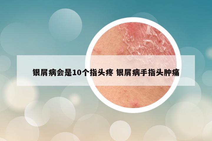 银屑病会是10个指头疼 银屑病手指头肿痛