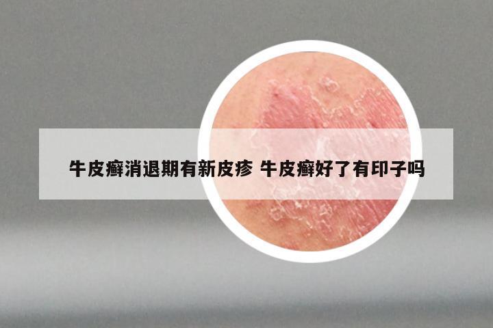 牛皮癣消退期有新皮疹 牛皮癣好了有印子吗