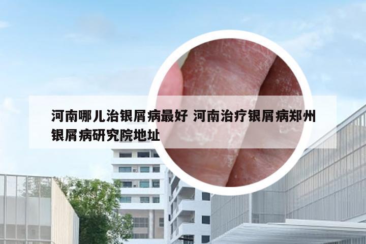 河南哪儿治银屑病最好 河南治疗银屑病郑州银屑病研究院地址