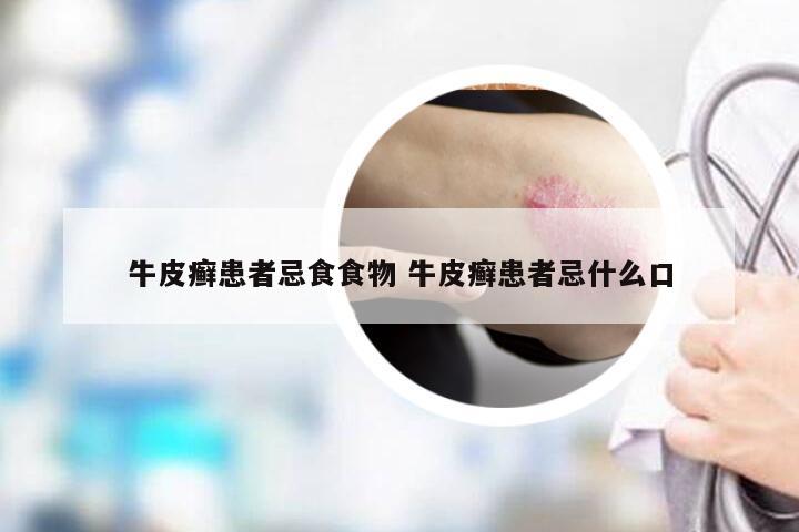 牛皮癣患者忌食食物 牛皮癣患者忌什么口