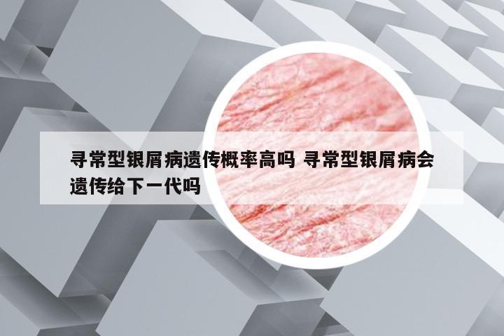 寻常型银屑病遗传概率高吗 寻常型银屑病会遗传给下一代吗