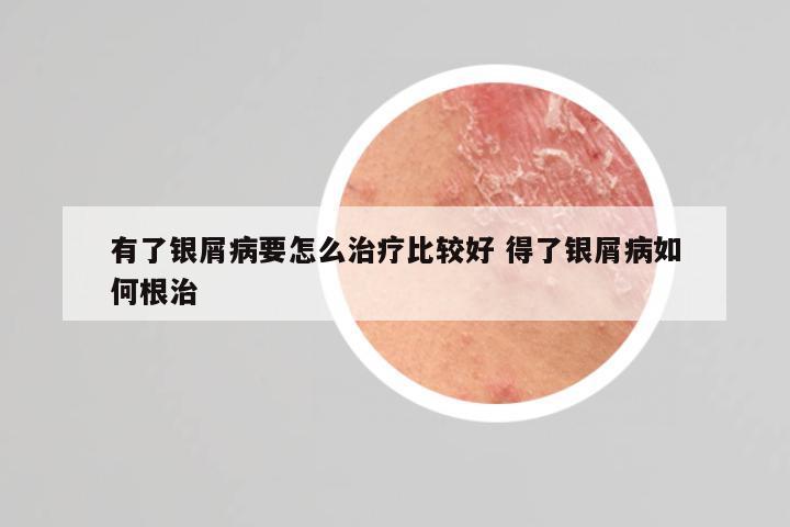 有了银屑病要怎么治疗比较好 得了银屑病如何根治
