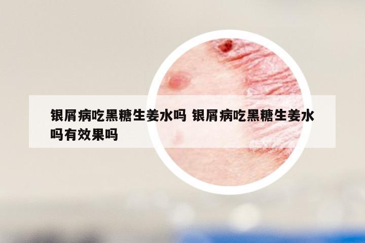 银屑病吃黑糖生姜水吗 银屑病吃黑糖生姜水吗有效果吗