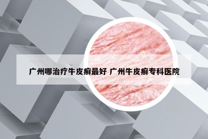 广州哪治疗牛皮癣最好 广州牛皮癣专科医院