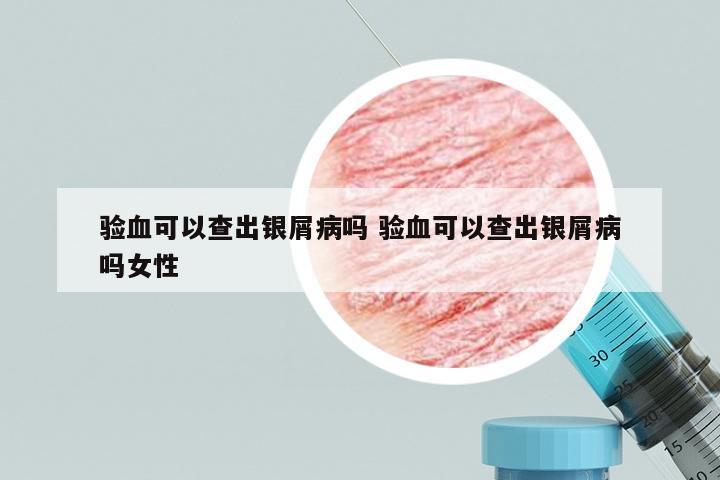 验血可以查出银屑病吗 验血可以查出银屑病吗女性