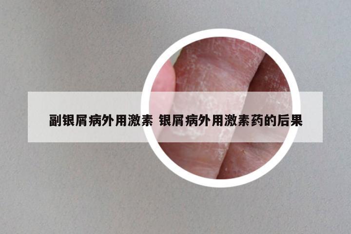 副银屑病外用激素 银屑病外用激素药的后果