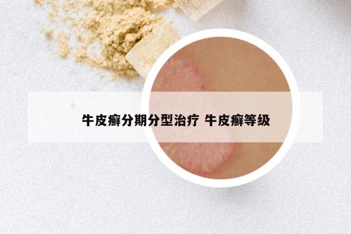 牛皮癣分期分型治疗 牛皮癣等级
