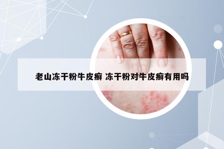 老山冻干粉牛皮癣 冻干粉对牛皮癣有用吗