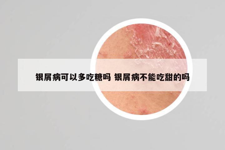 银屑病可以多吃糖吗 银屑病不能吃甜的吗
