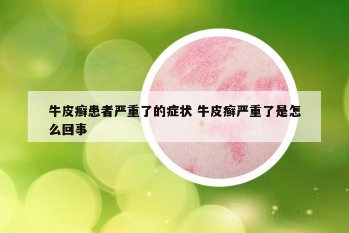 牛皮癣患者严重了的症状 牛皮癣严重了是怎么回事