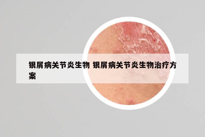 银屑病关节炎生物 银屑病关节炎生物治疗方案