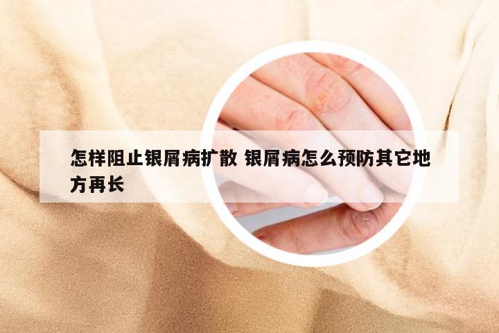 怎样阻止银屑病扩散 银屑病怎么预防其它地方再长