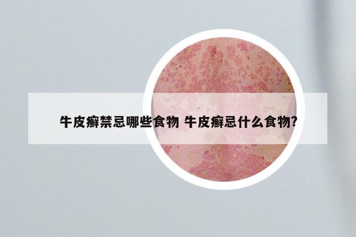 牛皮癣禁忌哪些食物 牛皮癣忌什么食物?