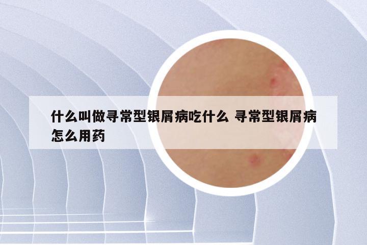 什么叫做寻常型银屑病吃什么 寻常型银屑病怎么用药