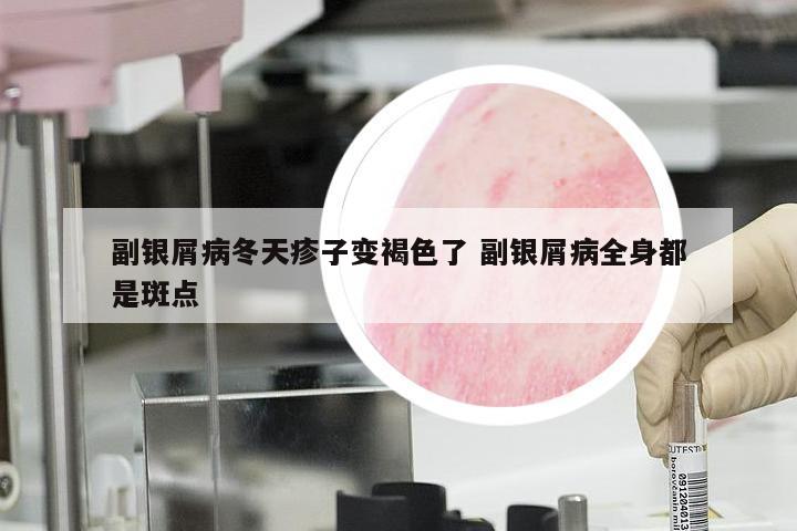 副银屑病冬天疹子变褐色了 副银屑病全身都是斑点