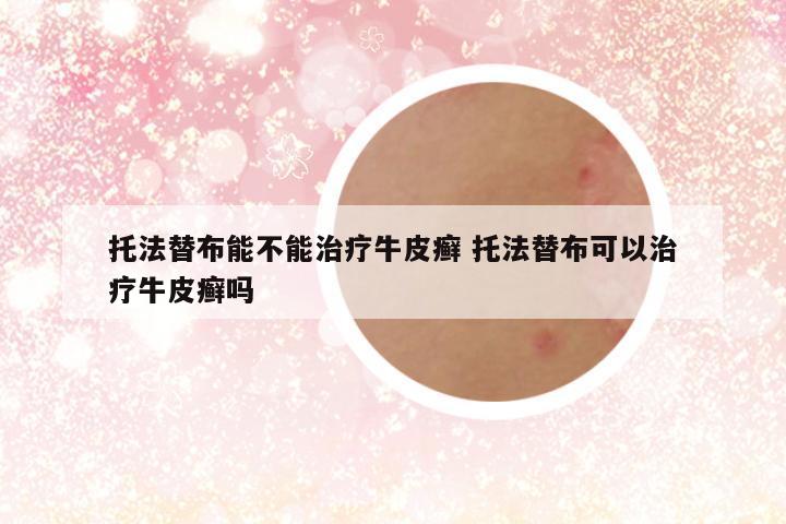 托法替布能不能治疗牛皮癣 托法替布可以治疗牛皮癣吗