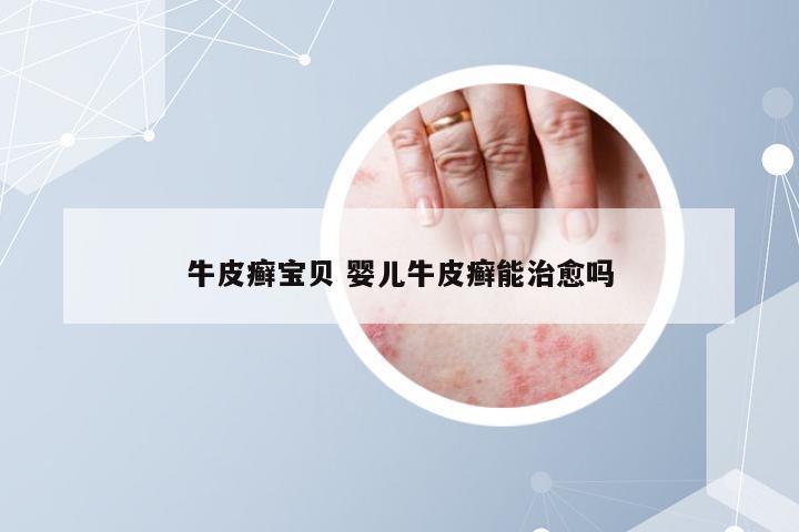 牛皮癣宝贝 婴儿牛皮癣能治愈吗