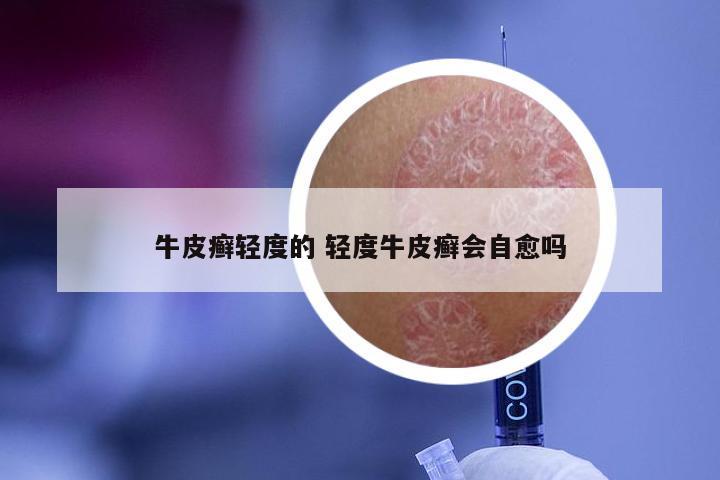 牛皮癣轻度的 轻度牛皮癣会自愈吗