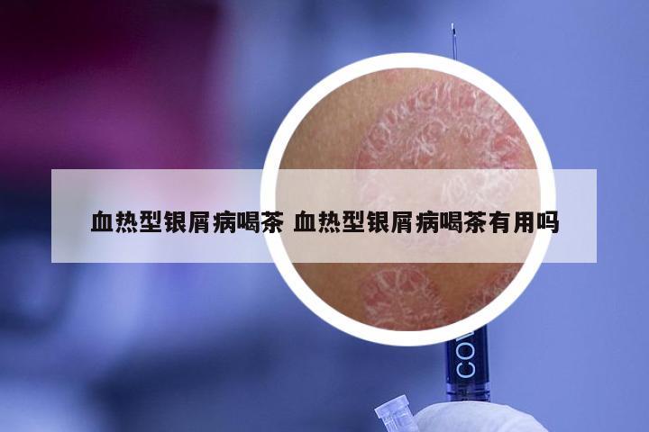 血热型银屑病喝茶 血热型银屑病喝茶有用吗