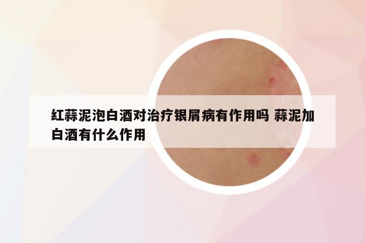 红蒜泥泡白酒对治疗银屑病有作用吗 蒜泥加白酒有什么作用