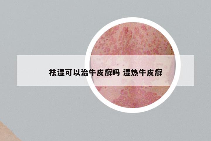 祛湿可以治牛皮癣吗 湿热牛皮癣