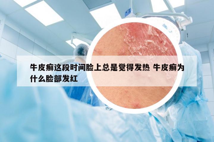 牛皮癣这段时间脸上总是觉得发热 牛皮癣为什么脸部发红