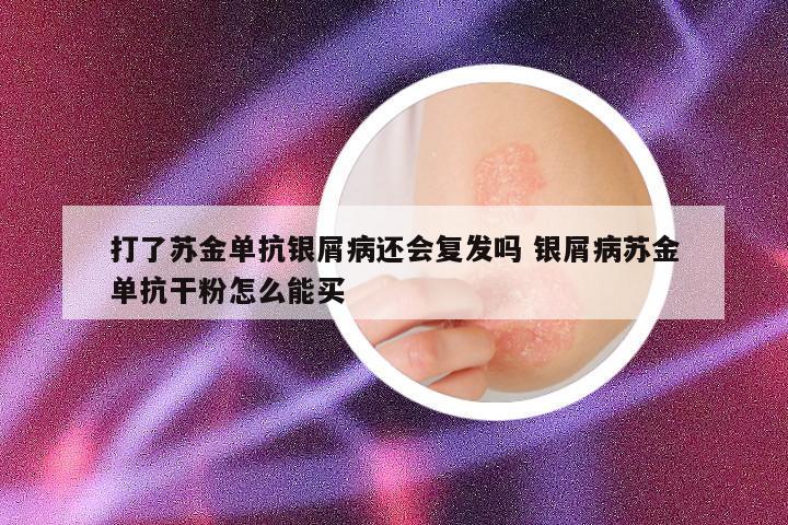 打了苏金单抗银屑病还会复发吗 银屑病苏金单抗干粉怎么能买