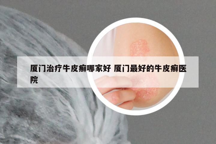 厦门治疗牛皮癣哪家好 厦门最好的牛皮癣医院