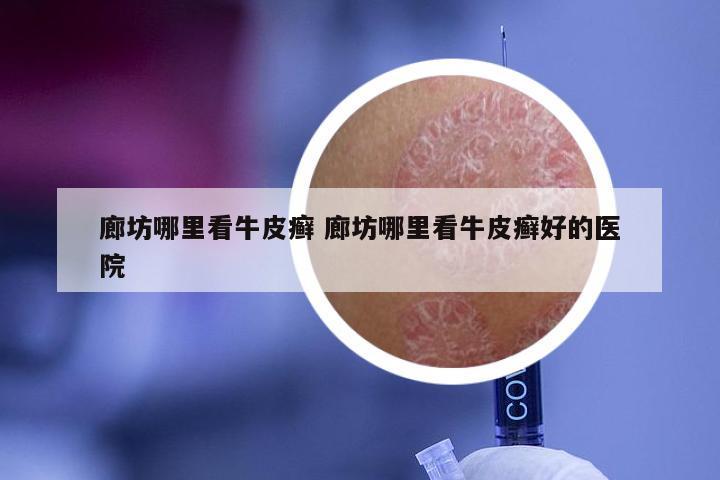 廊坊哪里看牛皮癣 廊坊哪里看牛皮癣好的医院