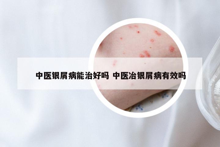 中医银屑病能治好吗 中医冶银屑病有效吗