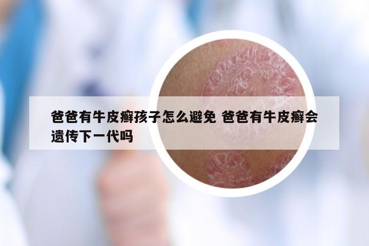 爸爸有牛皮癣孩子怎么避免 爸爸有牛皮癣会遗传下一代吗