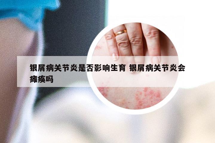 银屑病关节炎是否影响生育 银屑病关节炎会瘫痪吗