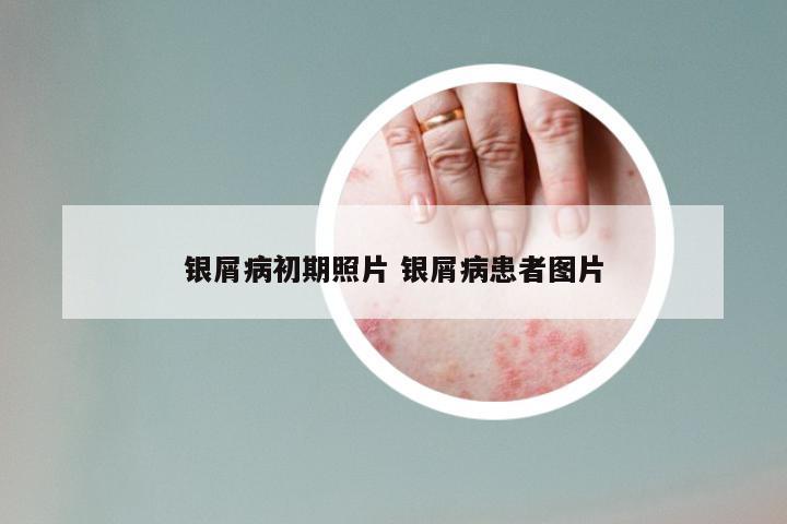 银屑病初期照片 银屑病患者图片
