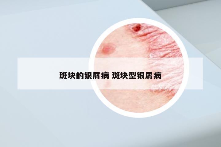 斑块的银屑病 斑块型银屑病