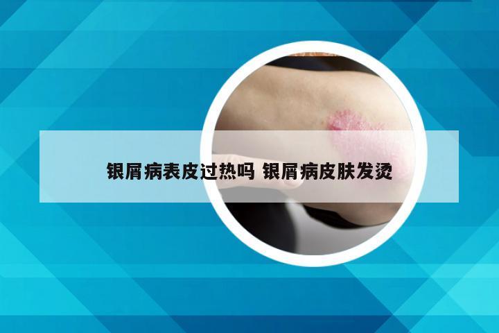 银屑病表皮过热吗 银屑病皮肤发烫