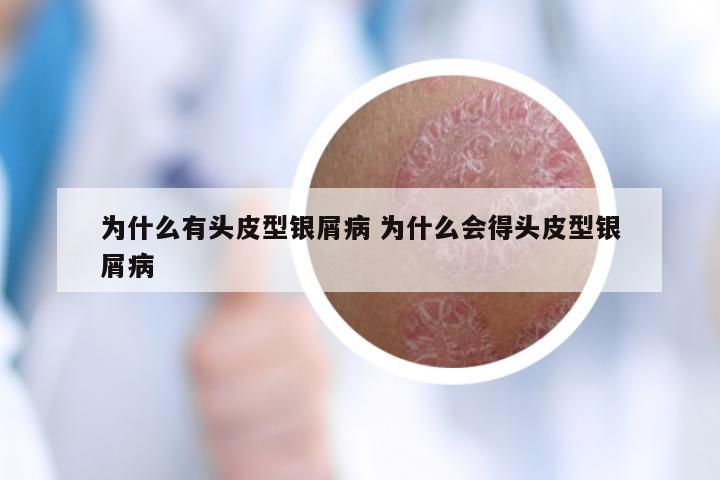 为什么有头皮型银屑病 为什么会得头皮型银屑病