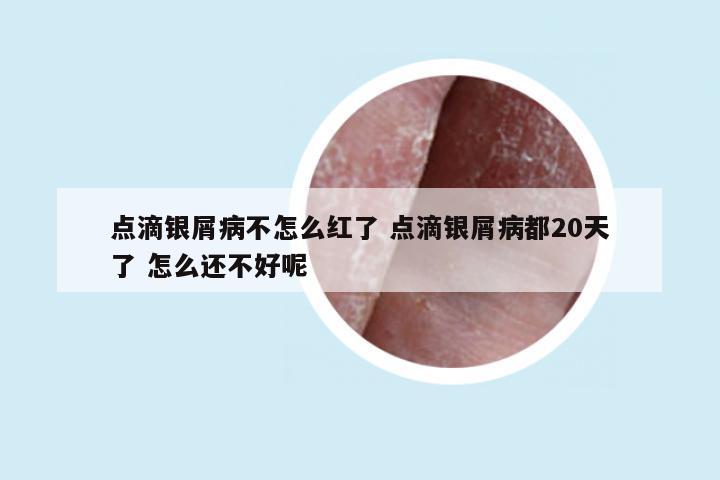 点滴银屑病不怎么红了 点滴银屑病都20天了 怎么还不好呢