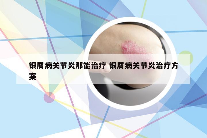 银屑病关节炎那能治疗 银屑病关节炎治疗方案