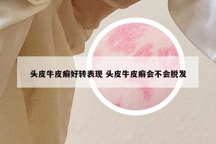 头皮牛皮癣好转表现 头皮牛皮癣会不会脱发