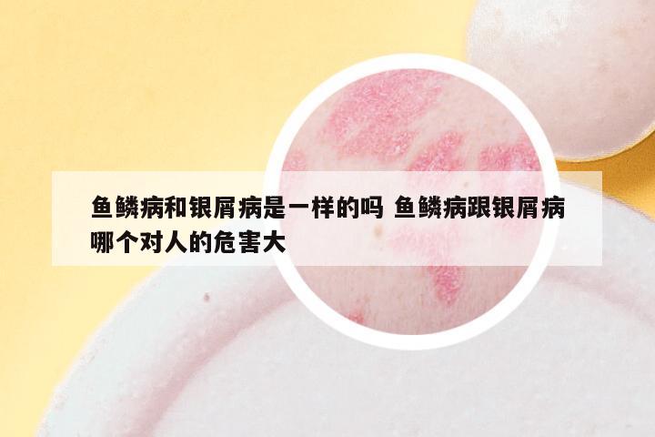 鱼鳞病和银屑病是一样的吗 鱼鳞病跟银屑病哪个对人的危害大