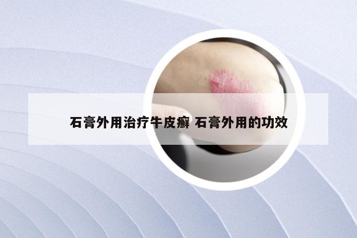 石膏外用治疗牛皮癣 石膏外用的功效