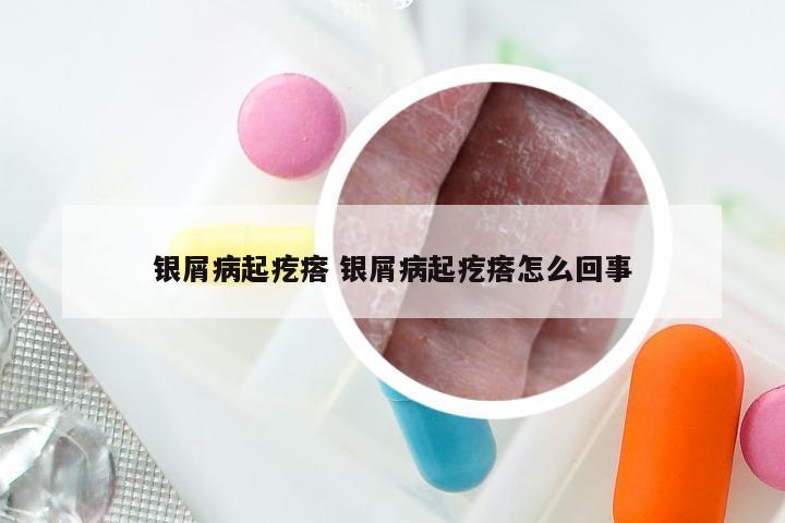 银屑病起疙瘩 银屑病起疙瘩怎么回事